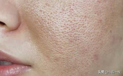 脸上长了小颗粒而且起皮特别糙,脸上皮肤又干又糙怎么办