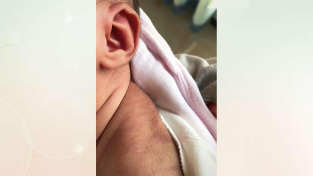 刚出生的婴儿背上长毛怎么回事,新生儿后背有黑色长毛