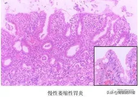 无痛胃肠镜为什么要常规活检,胃肠镜要不要取活检