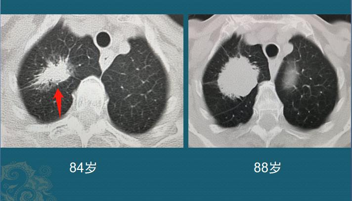 肺结节1.7x1.4磨玻璃结节严重吗,磨玻璃肺结节要动手术吗