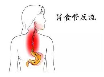 胃食管反流治疗药物有哪些,治疗胃食管反流病的首选药物是