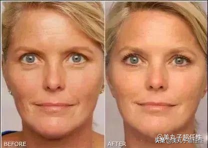 一招解决抬头纹的方法,抬头纹真正解决办法