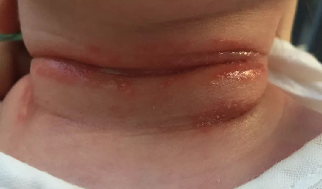 宝宝出现淹脖子怎么办,胖宝宝淹脖子怎么护理