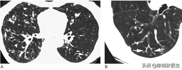 每天都有吐不完的痰能治好吗,每天都有吐不完的痰要不要去拍片