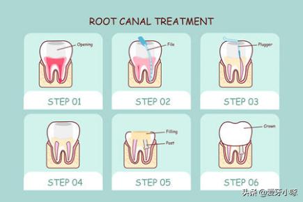 蛀牙如何避免踩坑,发现蛀牙了一周之后补来得及吗