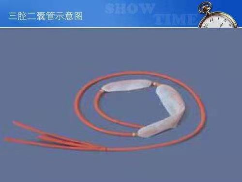 汉阴县中医医院运用三腔二囊管技术救治消化道出血病人