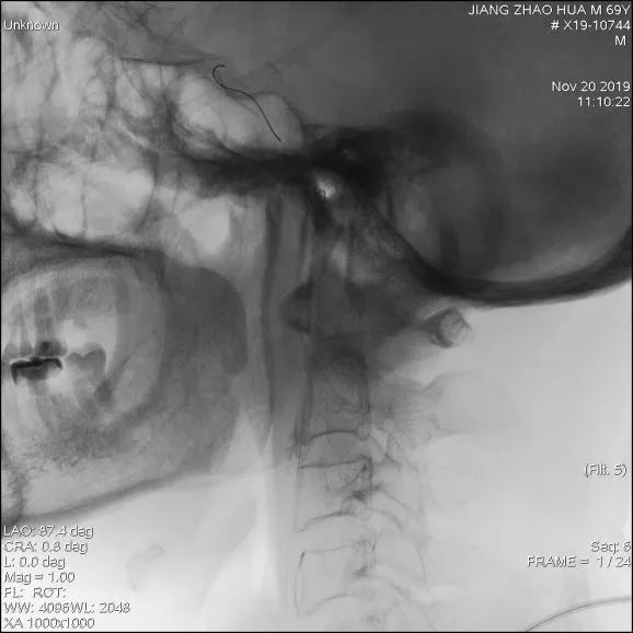 颅内覆膜支架应用于肿瘤侵袭性颈内动脉治疗