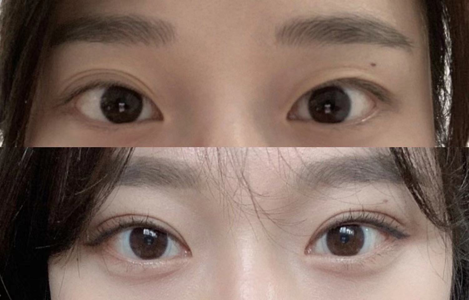 两点微创双眼皮是永久的吗,微创双眼皮术后眼角特别红