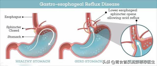 胃食管反流会导致持续性胸痛吗,晚上胃食管反流睡觉会胸痛怎么办