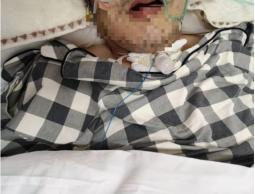 卒中后肺炎指南,脑卒中引起的肺部感染护理措施