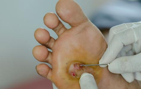 糖尿病足发黑并溃烂还能坚持多久,糖尿病足一级溃烂最佳治疗方法