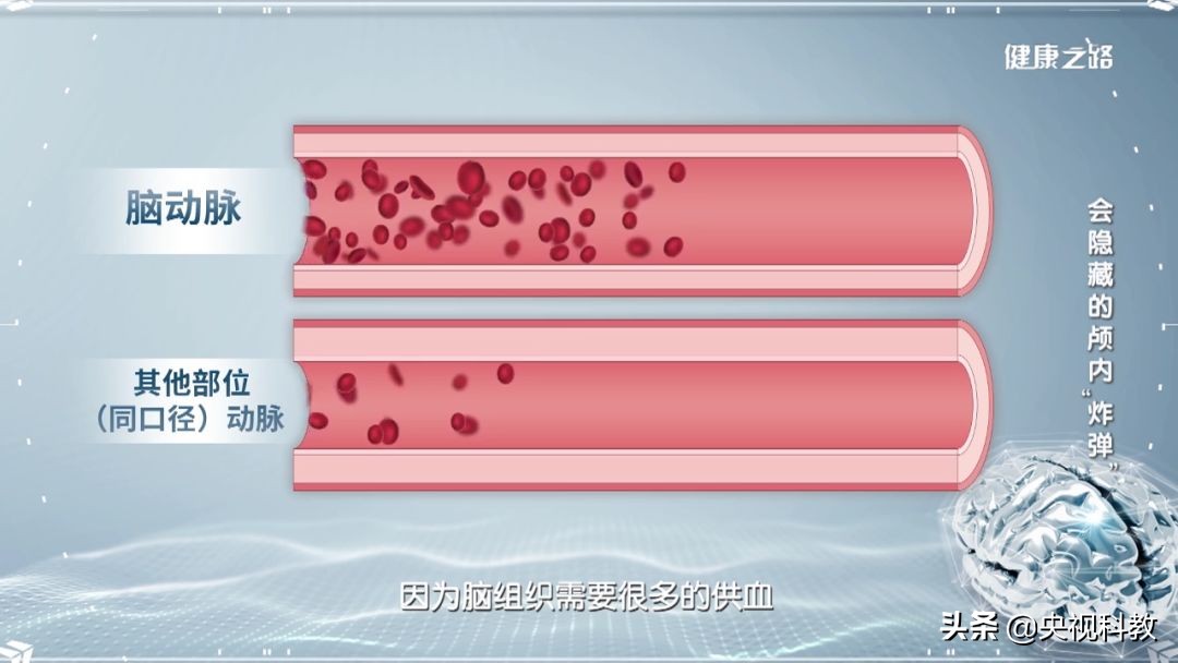 脑动脉瘤能吃腌制食品吗,过度食用腌制食品