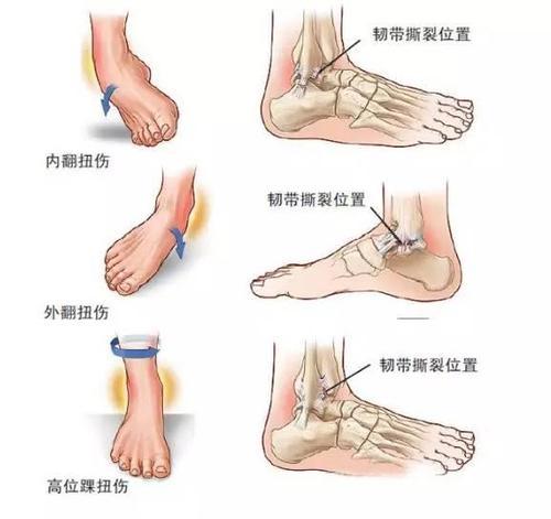 什么球鞋保护跟腱,保护脚踝的球鞋推荐