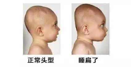 婴儿头型怎么定型好看,婴儿头型怎么睡才是正常头型