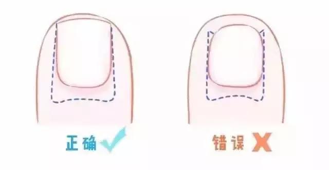 治疗甲沟炎真正有效的办法,甲沟炎指甲剪神器正品
