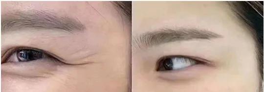 眼纹怎么针对性护理,眼纹的正确用法