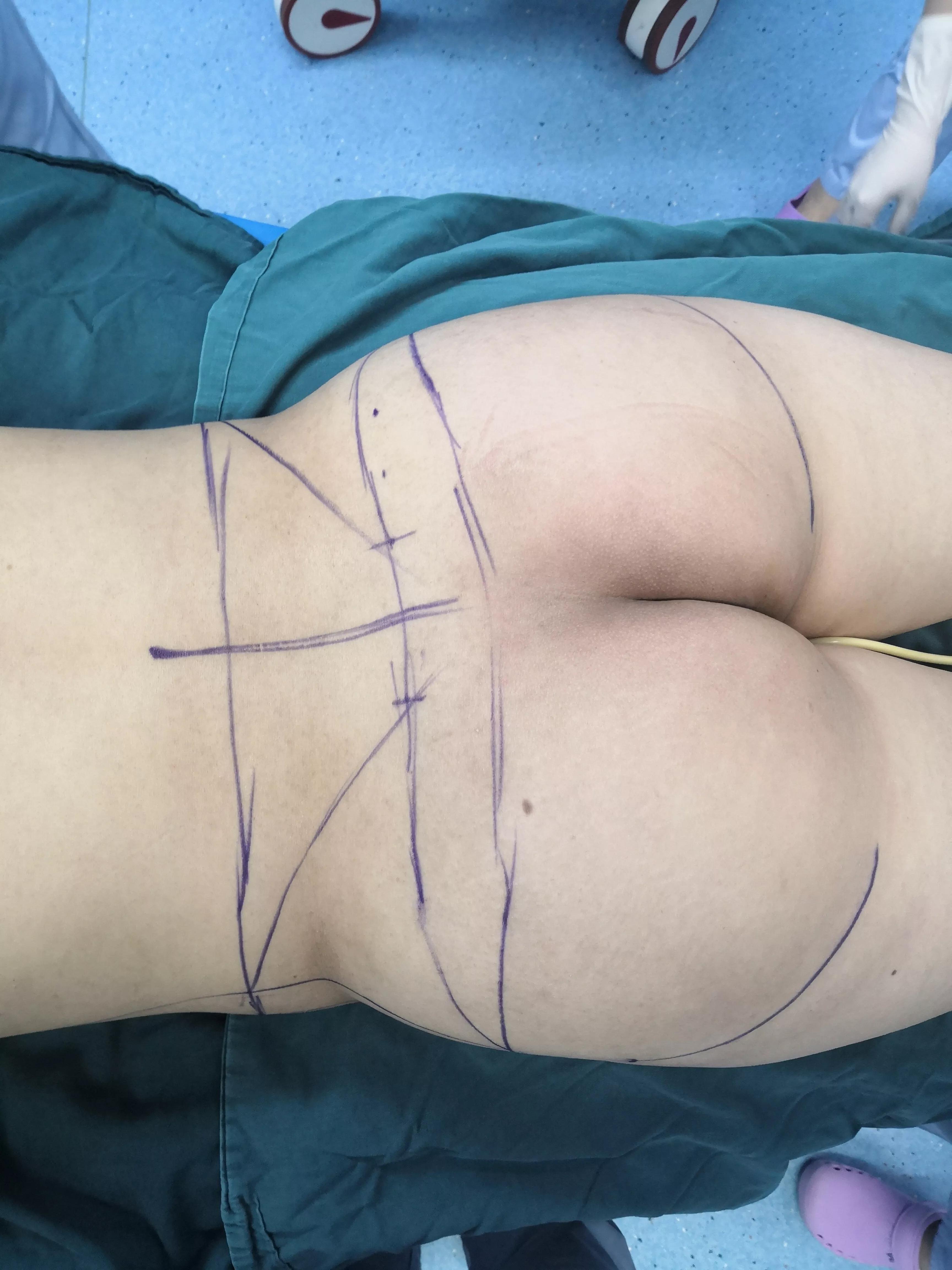 大腿吸脂手术多少钱权威李春财,大腿吸脂手术多少钱优秀李春财