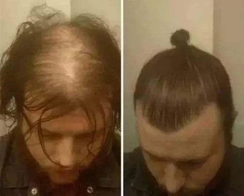 90后没有发际线,90后00后如何不脱发