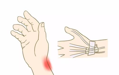 腱鞘炎手指解说图,腱鞘炎介绍