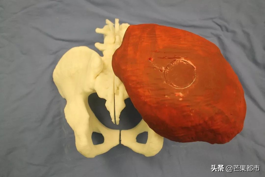 男子臀部长肿瘤,男子长巨瘤切除