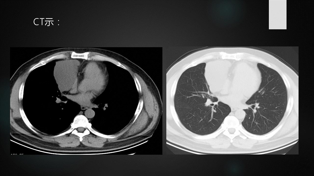 前上纵隔高密度影考虑胸腺未退化,肺纵隔胸腺结节12mm看什么科