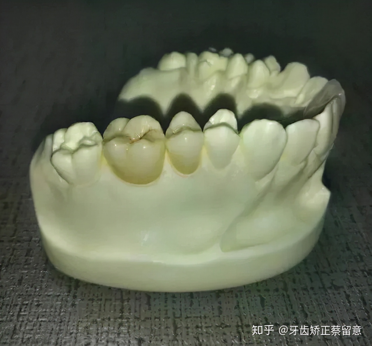 全瓷牙冠戴好了感觉咬合高了,戴了牙冠感觉大牙咬合不住