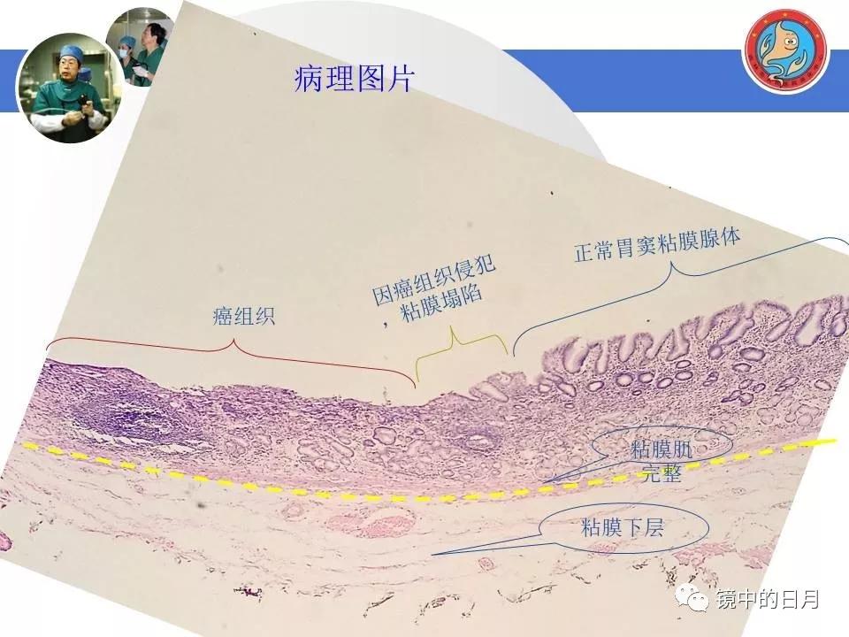 低分化胃癌早期时候做内镜手术吗,早期胃癌内镜手术后追加外科手术
