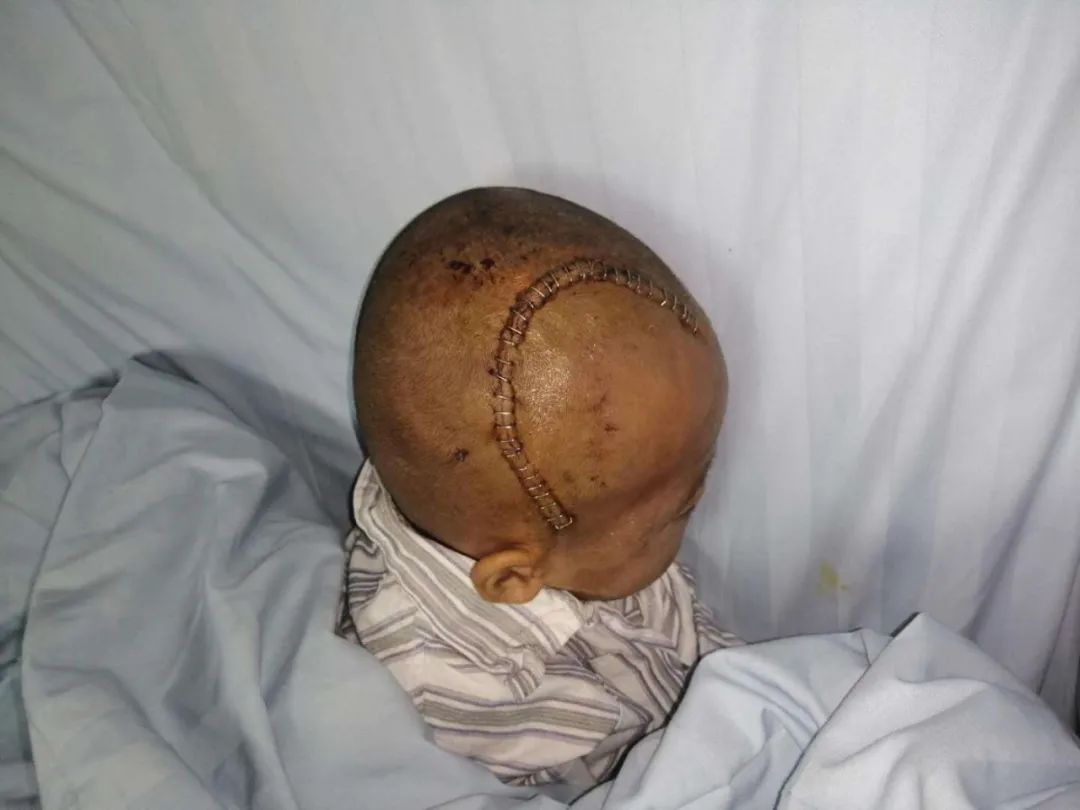 老公抗癌头发剃光,头发剃光的抗癌男孩