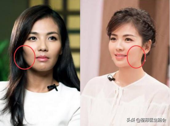 颧骨磨骨苹果肌下垂如何修复,如何判断是苹果肌还是高颧骨