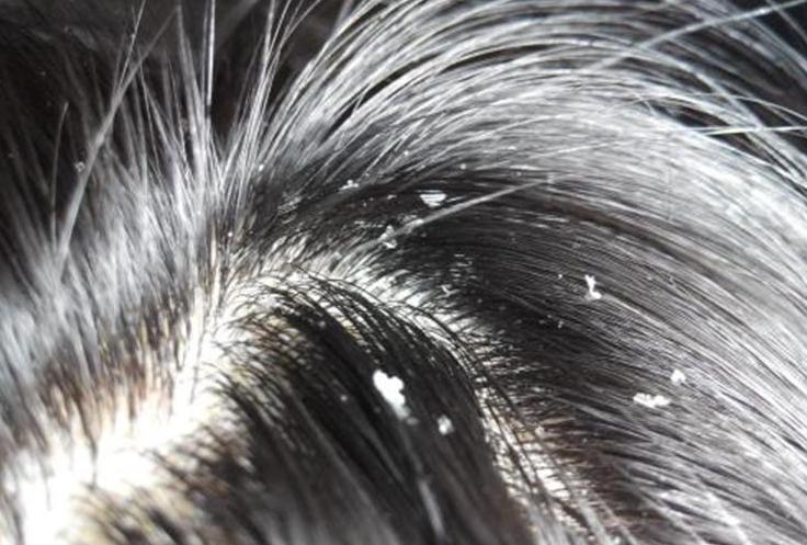 头发爱出油和掉头发妙招,头发上有头螨怎么消除