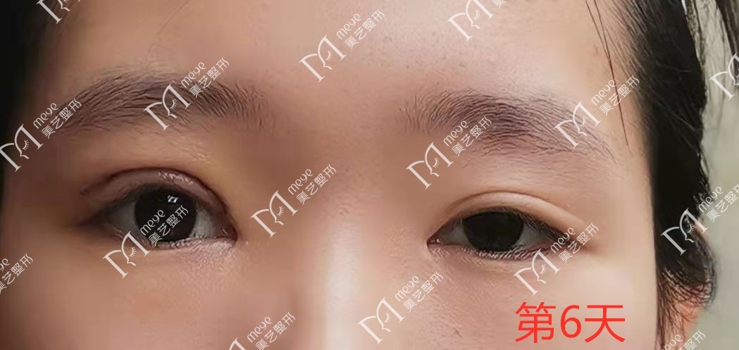 单眼上睑下垂修复术,上睑下垂眼睛修复手术成功率高吗