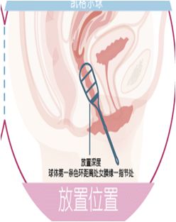 苏州阿姨30多年的难言之隐终解决，这个病许多妈妈有