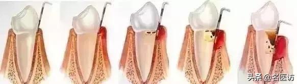 洗牙和牙周刮治区别在哪里,洗牙刚洗好隔天能做牙周刮治吗