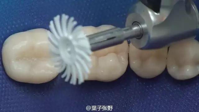 补牙疼吗补牙过程图,补牙全部过程是什么样子的