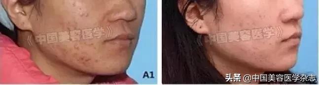 不怕人设崩塌，就怕皮肤太差！治疗重、中、轻*疮痤**临床论文分享！