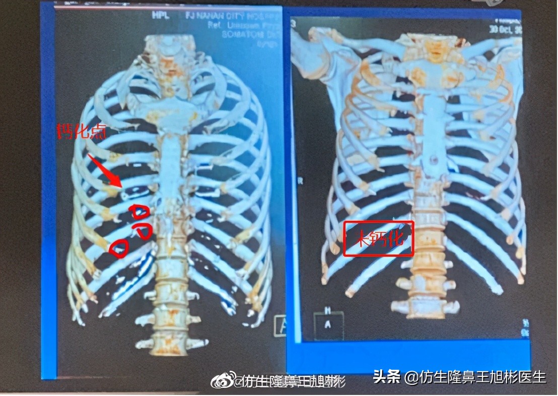 肋软骨鼻综合多久钙化,肋骨钙化可以做软骨鼻综合吗