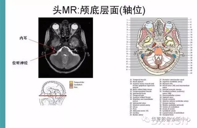 电子版头颅ct与mri断层解剖,头颅mri血管解剖与分段详解