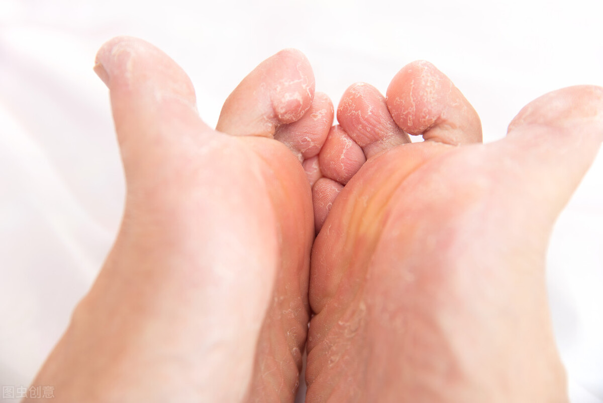 得了脚气病怎么办？日常防治的方法有哪些？记住这4点