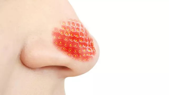 靠谱的去黑头方法,公认最有效的去黑头方法