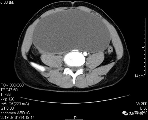 轻微子宫内膜异位症病历单,病理报告子宫内膜异位囊肿