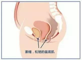 笑会流尿出来是什么原因,笑尿了正常吗健康科普