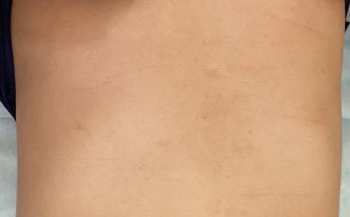 玫瑰糠疹如何治疗和注意事项,花斑糠疹和玫瑰糠疹有什么区别