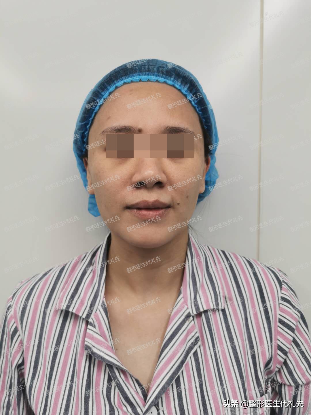 做微创过程,超微创小切口面部提升维持多久