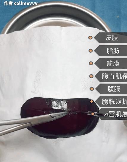 我在快手上看人切洋葱，竟然弄懂了剖腹产？