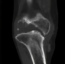 痛风膝关节红肿疼痛如何快速消除,膝关节痛风性关节炎mri表现