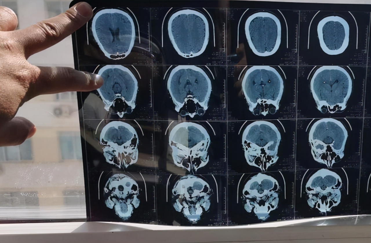 钙化是否说明病已好了,如何知道钙化呈现什么形状