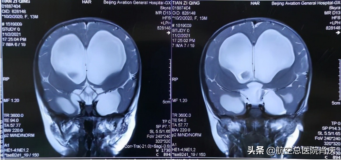 鞍上池蛛网膜囊肿手术费用,鞍上池蛛网膜囊肿影响智力吗
