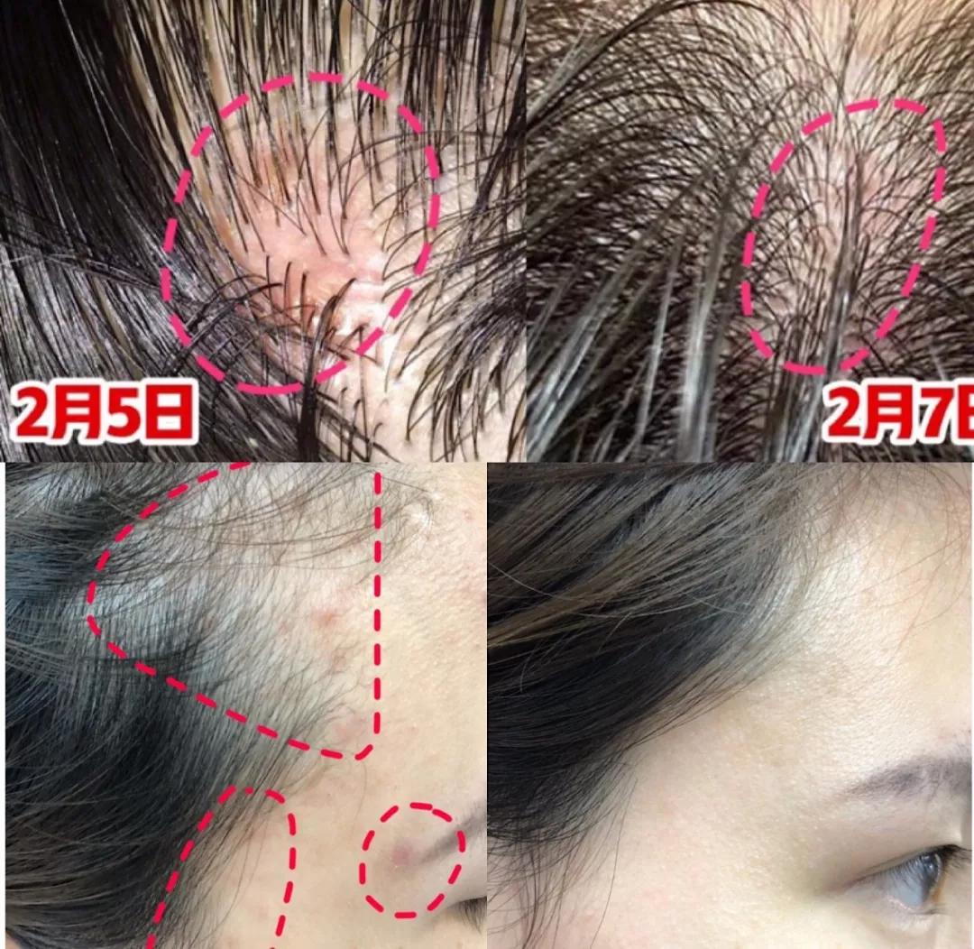 头油头皮屑多脱发洗发水,头油头皮屑多洗发水推荐