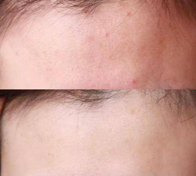 刷酸到底好不好,美容刷酸的副作用是什么