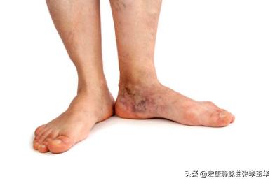 下肢静脉曲张外观不好看怎么办,下肢静脉曲张很难看怎么办